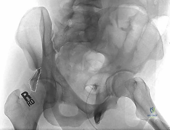 التخطيط الجراحي لكسور الحُق