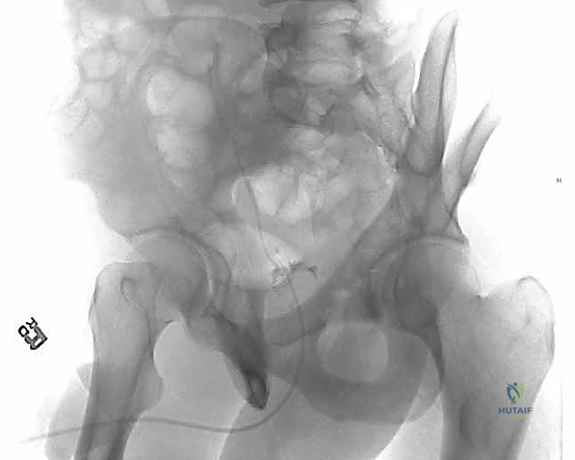 تقييم الكسر بالأشعة المقطعية