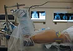 استخدام الشرائح والمسامير للتثبيت