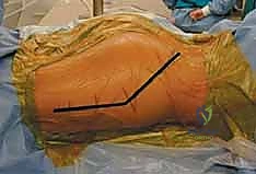 تنظيف المفصل وإزالة الشظايا