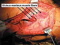 إعادة التوافق المفصلي الدقيق