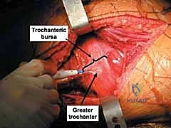 تثبيت مبدئي للشظايا العظمية