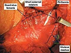 مراجعة التثبيت بالأشعة داخل العمليات