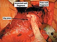 إغلاق الجرح والطبقات التشريحية