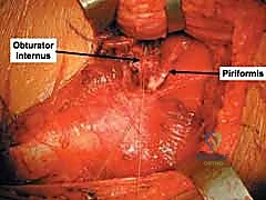 تثبيت الجدار الخلفي بدقة