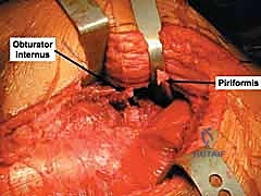 إتقان علاج كسور الجدار الخلفي للحُق: دليلك الشامل لتعافي مفصل الورك