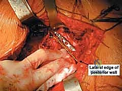 صورة توضيحية لـ إتقان علاج كسور الجدار الخلفي للحُق: دليلك الشامل لتعافي مفصل الورك