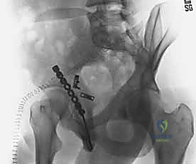 وضع الشرائح الداعمة الإضافية