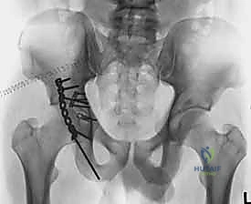 التثبيت النهائي للكسر