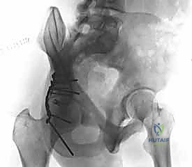 Illustration of posterior wall fractures - Dr. Mohammed Hutaif