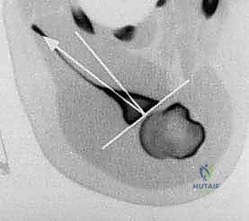 دور الكفة المدورة في استقرار الكتف