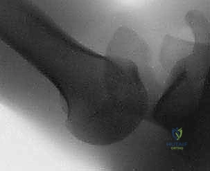 تمزق الشفا الحقاني الخلفي وآلية حدوث الخلع