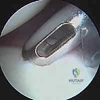 أعراض ألم الكتف الخلفي والشعور بالانزلاق