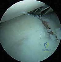 صورة طبية: تثبيت الكتف الخلفي بالمنظار: دليل شامل لاستعادة الاستقرار مع الأستاذ الدكتور محمد هطيف