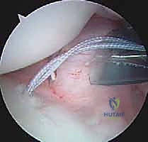 صورة طبية: تثبيت الكتف الخلفي بالمنظار: دليل شامل لاستعادة الاستقرار مع الأستاذ الدكتور محمد هطيف