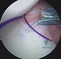 صورة توضيحية لـ تثبيت الكتف الخلفي بالمنظار: دليل شامل لاستعادة الاستقرار مع الأستاذ الدكتور محمد هطيف