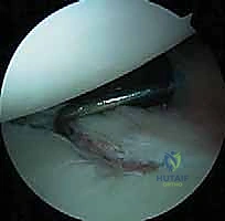 تأثير رفع الأثقال والإجهاد المتكرر على الكتف