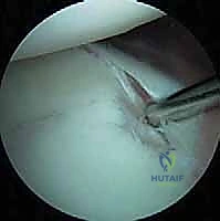 إصابات الكتف الرياضية والخلع الخلفي