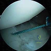 العيوب العظمية وآفة هيل ساكس العكسية