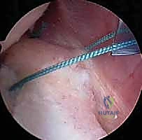 صورة طبية: تثبيت الكتف الخلفي بالمنظار: دليل شامل لاستعادة الاستقرار مع الأستاذ الدكتور محمد هطيف