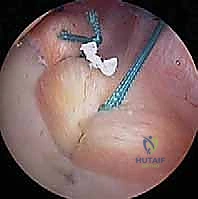صورة طبية: تثبيت الكتف الخلفي بالمنظار: دليل شامل لاستعادة الاستقرار مع الأستاذ الدكتور محمد هطيف