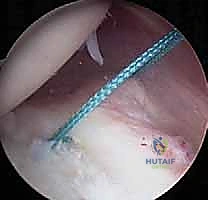 صورة توضيحية لـ تثبيت الكتف الخلفي بالمنظار: دليل شامل لاستعادة الاستقرار مع الأستاذ الدكتور محمد هطيف