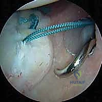 تثبيت الكتف الخلفي بالمنظار: دليل شامل لاستعادة الاستقرار مع الأستاذ الدكتور محمد هطيف