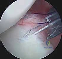 صورة طبية: تثبيت الكتف الخلفي بالمنظار: دليل شامل لاستعادة الاستقرار مع الأستاذ الدكتور محمد هطيف