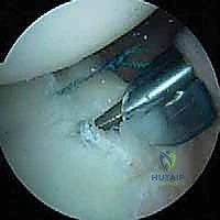 صورة توضيحية لـ تثبيت الكتف الخلفي بالمنظار: دليل شامل لاستعادة الاستقرار مع الأستاذ الدكتور محمد هطيف