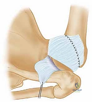 صورة توضيحية لـ تثبيت الكتف الخلفي بالمنظار: دليل شامل لاستعادة الاستقرار مع الأستاذ الدكتور محمد هطيف