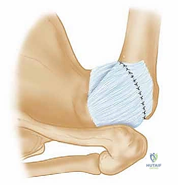 صورة توضيحية لـ تثبيت الكتف الخلفي بالمنظار: دليل شامل لاستعادة الاستقرار مع الأستاذ الدكتور محمد هطيف