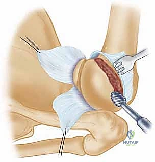 صورة طبية: تثبيت الكتف الخلفي بالمنظار: دليل شامل لاستعادة الاستقرار مع الأستاذ الدكتور محمد هطيف