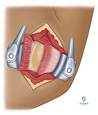 صورة توضيحية لـ تثبيت الكتف الخلفي بالمنظار: دليل شامل لاستعادة الاستقرار مع الأستاذ الدكتور محمد هطيف