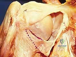 صورة طبية: تثبيت الكتف الخلفي بالمنظار: دليل شامل لاستعادة الاستقرار مع الأستاذ الدكتور محمد هطيف