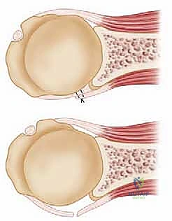 التصوير بالرنين المغناطيسي والأشعة المقطعية للكتف