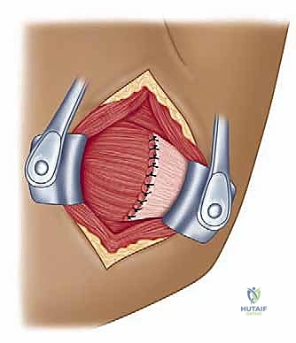 مقارنة خيارات العلاج واتخاذ القرار الطبي