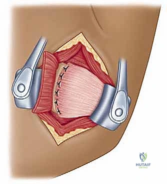 صورة طبية: تثبيت الكتف الخلفي بالمنظار: دليل شامل لاستعادة الاستقرار مع الأستاذ الدكتور محمد هطيف