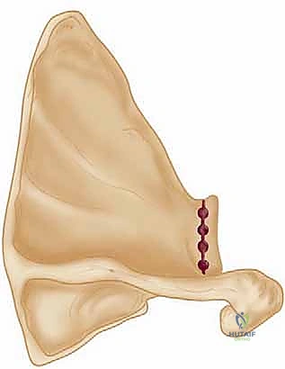 صورة طبية: تثبيت الكتف الخلفي بالمنظار: دليل شامل لاستعادة الاستقرار مع الأستاذ الدكتور محمد هطيف