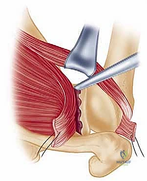 إدخال المنظار واستكشاف مفصل الكتف من الداخل