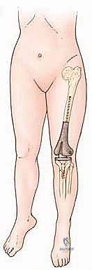 صورة طبية: بتر الفخذ فوق الركبة الأورامي: دليل شامل للمرضى وخبرة الأستاذ الدكتور محمد هطيف