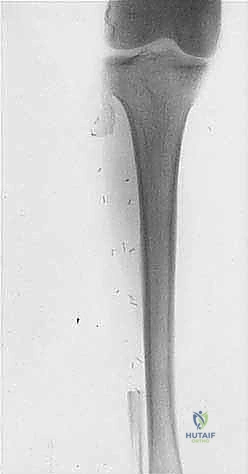 صورة توضيحية لـ بتر الفخذ فوق الركبة الأورامي: دليل شامل للمرضى وخبرة الأستاذ الدكتور محمد هطيف