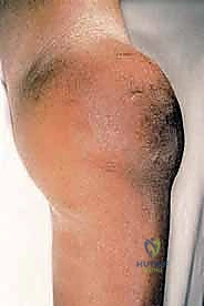 صورة توضيحية لـ بتر الفخذ فوق الركبة الأورامي: دليل شامل للمرضى وخبرة الأستاذ الدكتور محمد هطيف