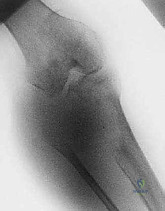 صورة توضيحية لـ بتر الفخذ فوق الركبة الأورامي: دليل شامل للمرضى وخبرة الأستاذ الدكتور محمد هطيف