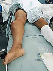 صورة توضيحية لـ بتر الفخذ فوق الركبة الأورامي: دليل شامل للمرضى وخبرة الأستاذ الدكتور محمد هطيف