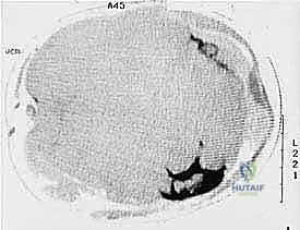 صورة توضيحية لـ بتر الفخذ فوق الركبة الأورامي: دليل شامل للمرضى وخبرة الأستاذ الدكتور محمد هطيف