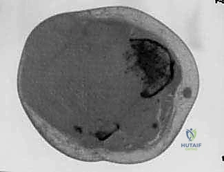 صورة توضيحية لـ بتر الفخذ فوق الركبة الأورامي: دليل شامل للمرضى وخبرة الأستاذ الدكتور محمد هطيف