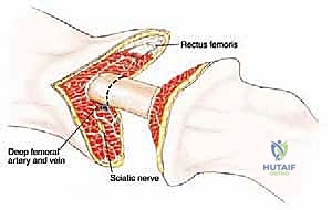صورة توضيحية لـ بتر الفخذ فوق الركبة الأورامي: دليل شامل للمرضى وخبرة الأستاذ الدكتور محمد هطيف