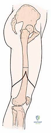 صورة توضيحية لـ بتر الفخذ فوق الركبة الأورامي: دليل شامل للمرضى وخبرة الأستاذ الدكتور محمد هطيف