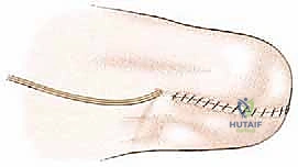 صورة توضيحية لـ بتر الفخذ فوق الركبة الأورامي: دليل شامل للمرضى وخبرة الأستاذ الدكتور محمد هطيف