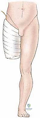 Transfemoral Amputation: An Oncologic Masterclass for Fellows